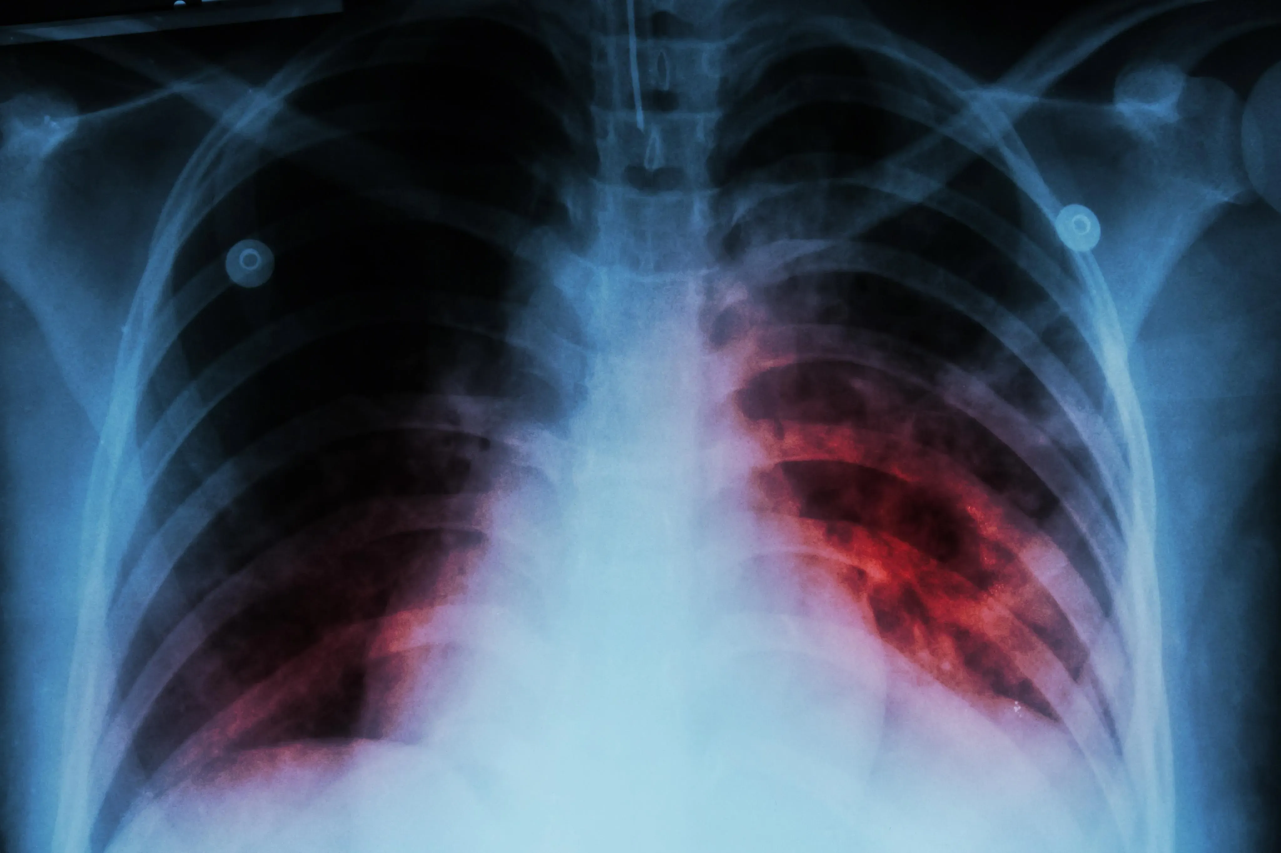 21.69 Lakh TB Cases Reported from January to October: Government Update