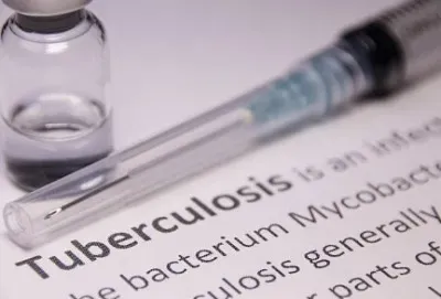 Government to Initiate 100-Day Campaign for TB Elimination
