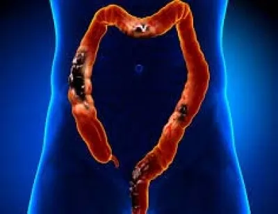 Can Gene-Editing Therapy Revolutionize Treatment for Advanced Colorectal Cancer?