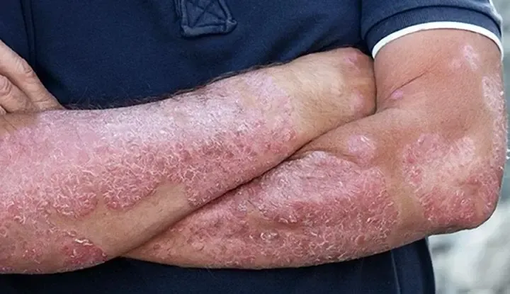 Global Atopic Dermatitis Cases Projected to Reach 42.42 Million by 2033: New Findings