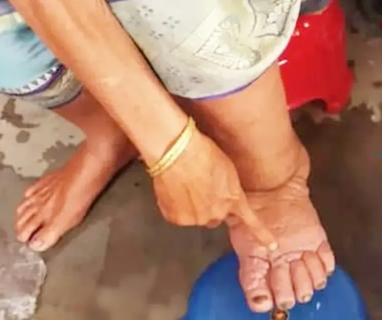 Gujarat to Implement Anti-Filariasis Initiative for 5.46 Lakh Residents