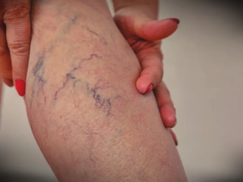 Chilly Feet and Heavy Legs? It Could Indicate Varicose Veins, Research Suggests