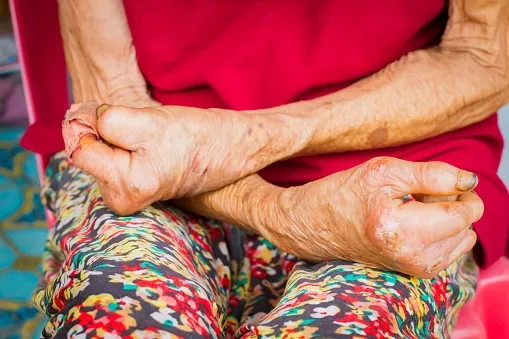 India Represents 53% of Global Leprosy Cases, Experts Call for Legal Reforms