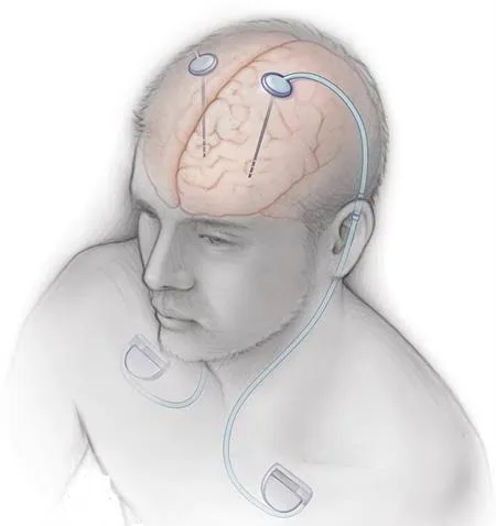 Indian Deep Brain Stimulator Market Expected to Achieve 10% CAGR by 2033: Analysis