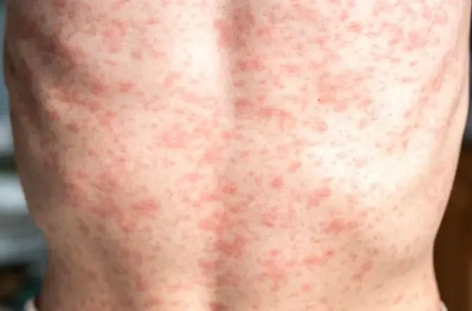 2024 Sees a Surge in Measles Cases in Europe, Highest Since 1997: WHO