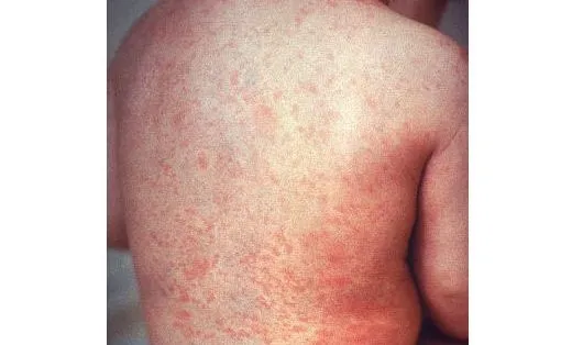 Mongolia Reports Additional Imported Measles Case