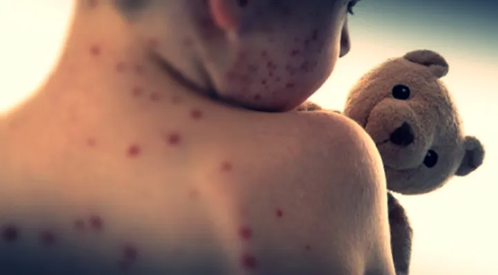 Has Mongolia's Confirmed Measles Cases Exceeded 3,000?