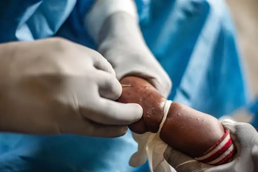 Mpox Fatalities in Africa Reach 260 Amidst Humanitarian Crisis in Congo