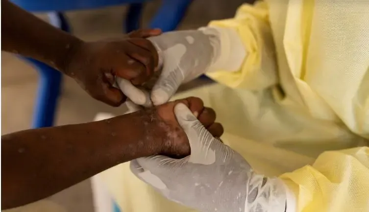Mpox Outbreak in Africa Raises Significant Concerns, According to WHO