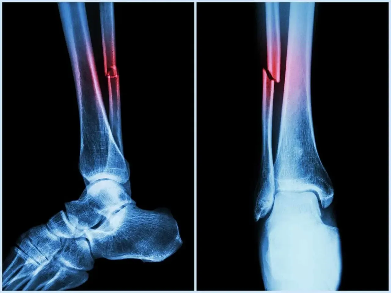 Can a New Machine Algorithm Identify Heart and Fracture Risks from Routine Bone Scans?