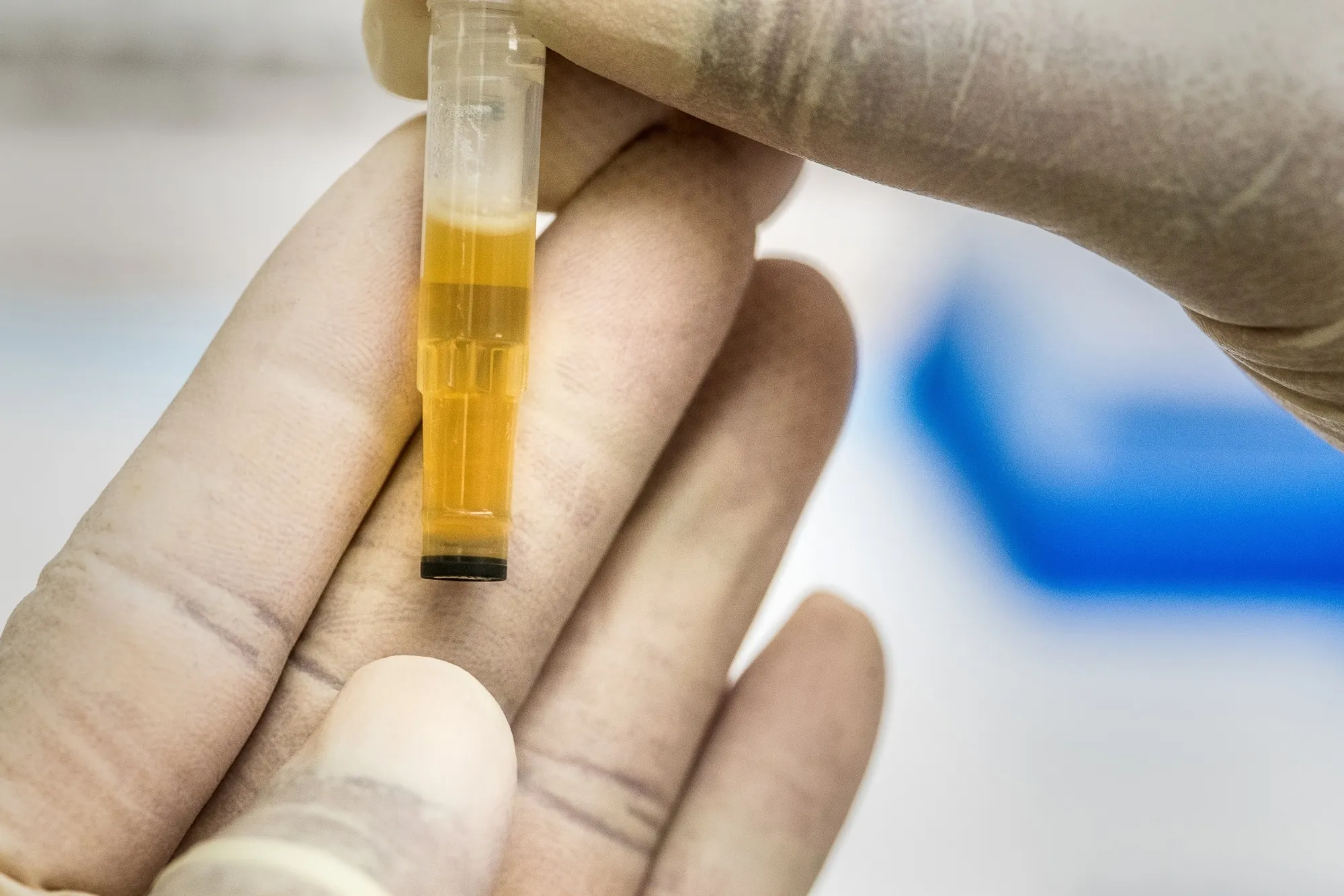 Is Urine Therapy Effective for Treating Diseases?
