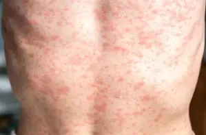 Why Are Over 900 Measles Cases Reported in the US in 2025?