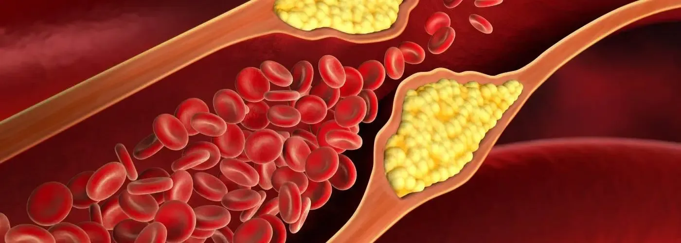 Lower Bad Cholesterol Levels to Combat Alzheimer’s and Dementia