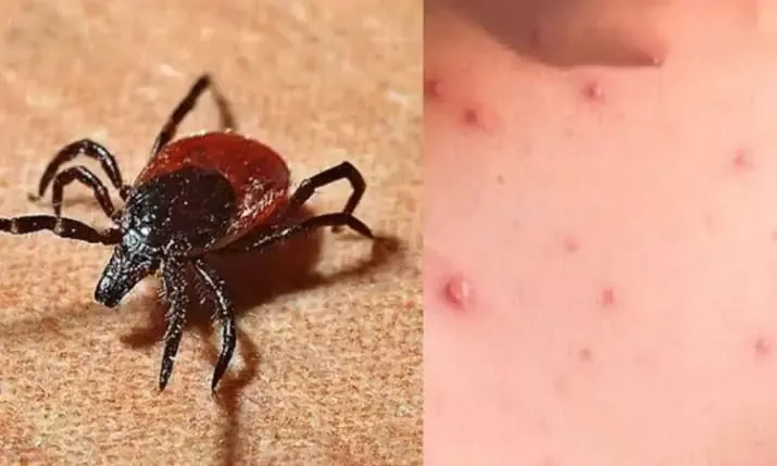 Rural Populations Face Elevated Scrub Typhus Infection Risks: Research