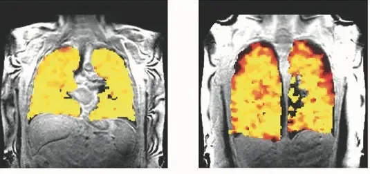 Researchers Create Advanced Lung Scan Revealing Functional Insights