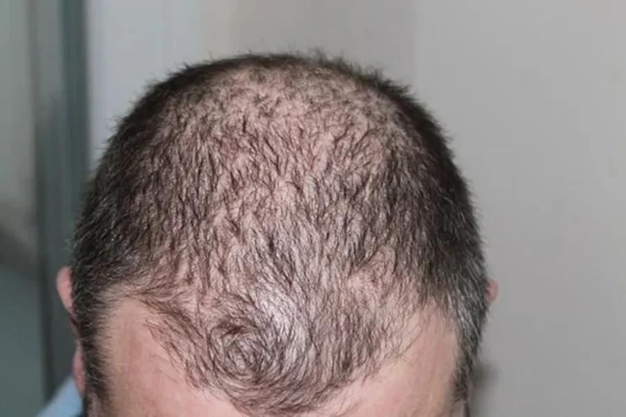 Research Indicates Low Dosages of Antibiotics Can Aid in Treating a Rare Hair Loss Condition
