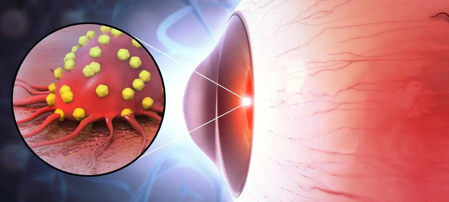 Research Unveils Innovative Drug Delivery System for Rare Eye Cancer