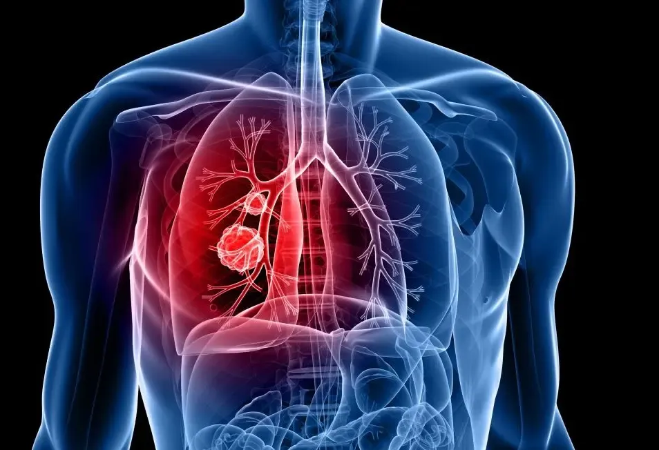 Research Indicates Tumor DNA in Blood Can Forecast Lung Cancer Prognosis