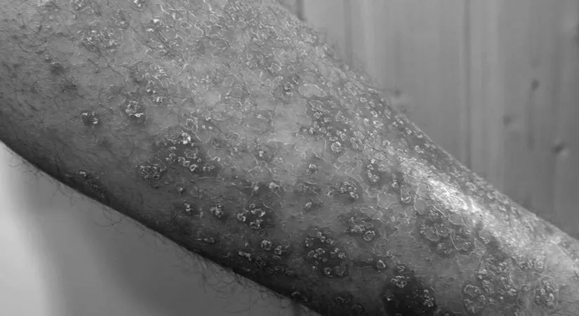 Why Are Psoriasis Patients at Increased Risk for Obesity and Fatty Liver Disease?