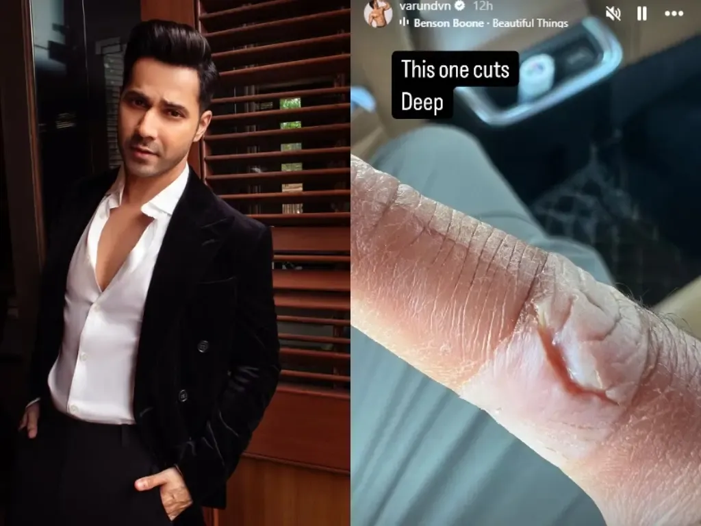Varun Dhawan Faces Injury, Reveals Serious Cut on Finger