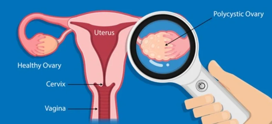 Could Women with PCOS Experience Attention and Cognitive Challenges?